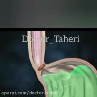 رفلکس معده و آسیب مری