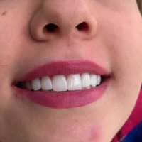 فینیر كمبوزیت الاسنان فی عیادة كوروش | مشهد |  ابتسامة هولیود وعدسات الأسنان
