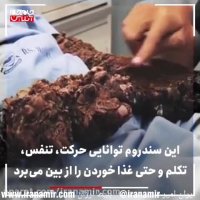 عجیب‌ترین سندروم‌های دنیا !