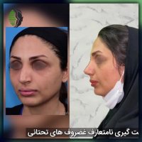 یکماه بعد از جراحی بینی استخوانی | دکتر باستانی نژاد | جراح بینی تهران