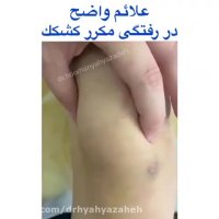 نشانه های در رفتگی کشکک زانو