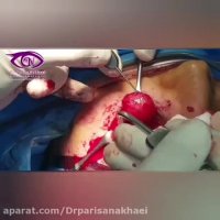 فیلم جراحی بیرون زدگی چشم چپ به دلیل تومور اربیت