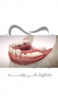 فیلم مراحل ایمپلنت دندان