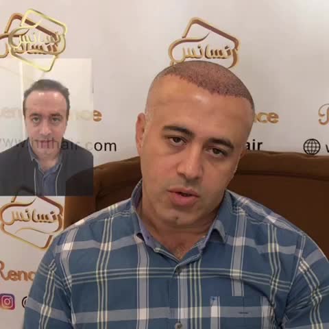 کاشت مو به روشSUT -کلینیک تخصصی رنسانس