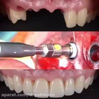 بازسازی دندان ها