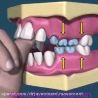 نامرتبی دندان در کودکان
