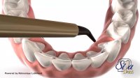 ریتینر ثابت | دندانپزشکی سیمادنت