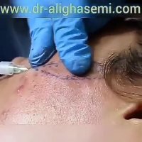 تزریق ژل گونه