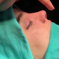 عمل بینی در مشهد |مشاوره 09380000893| عکس عمل بینی در مشهد