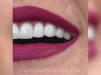 فیلم کامپوزیت دندان جلویی | کلینیک دندانپزشکی کوروش