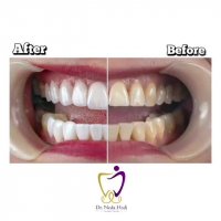 برای زیبا تر شدن دندان ها هیچ وقت دیر نیست