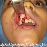 جراحی ایمپلنت دندان