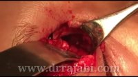 جراحی تومور بسیار وسیع کاسه چشم orbital tumor