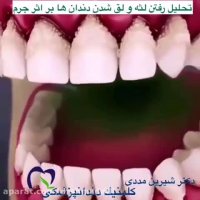 لق شدن دندان ها بر اثر جرم