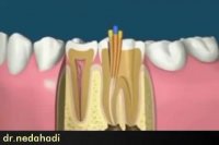 پوسیدگی و درمان ریشه دندان | دکتر ندا هادی