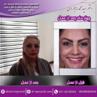 عمل زیبایی بینی و تزریق ژل زیر چشم توسط دکتر لاجوردی