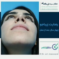 عمل بینی بعد از چهار سال!
