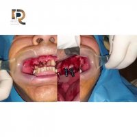 بازسازی کامل فک فوقانی