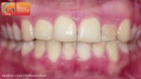 قبل و بعدارتودنسی بدون كشیدن دندان | دکتر مسعود داودیان