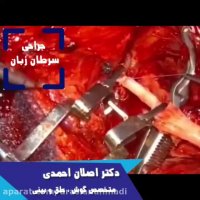 جراحی سرطان زبان