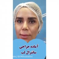 فیلم نتیجه سانترال لب 10 روز پس از جراحی (بلافاصله بعد از کشیدن بخیه)