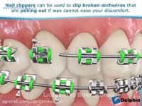 نحوه مدیریت ناراحتی های حین ارتودنسی | دکتر داوودیان