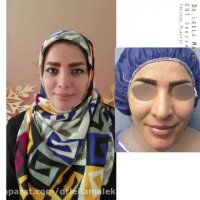 جراحی بینی طبیعی