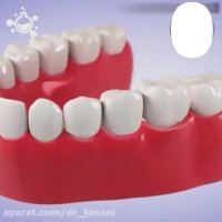 بریج ۳ واحدی دندان جهت پر کردن فضای خالی