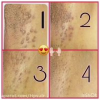 زگیل تناسلی چیست؟؟ چه علائمی دارد؟؟