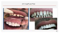 تخفیف ونیر کامپوزیت دندان در تهران