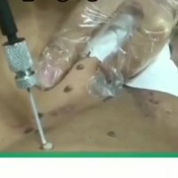 فریز یا لیزر برای زگیل