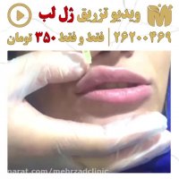 تزریق ژل لب فقط 350 تومن !!!1