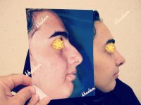 عمل بینی در مشهد | مشاوره رایگان 09380000893