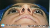 جراحی بینی استخوانی انحراف دار توسط دکتر امید ابراهیمی بهترین جراح بینی در تهران