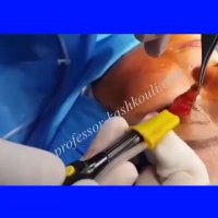 بلفاروپلاستی با امواج رادیویی | پروفسور کشکولی | جراح پلک تهران