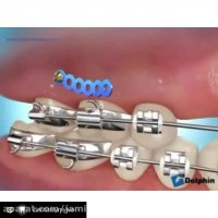 بزرگی فک بالا