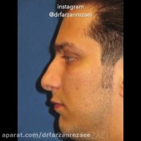 جراحی بینی برای آقایان