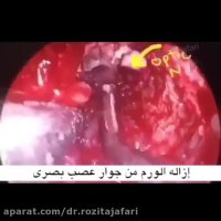 صداع فی ناحیه خلف العین