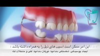 عوارض کشیدن دندان و عدم جایگزینی آن | سیمادنت