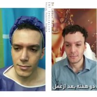 لیفت همزمان پیشانی و شقیقه