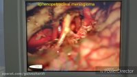 217. تومور بزرگ مننژیوم قاعده جمجمه