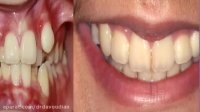 قبل و بعد ارتودنسی با کشیدن دندان | دکتر مسعود داودیان