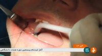 ایمپلنت دندان گزارشی از جهانگردی سلامت ایران