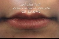 حجم دهی دائمی به لب ها !