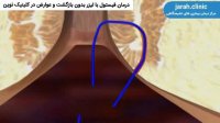 درمان فیستول با لیزر بدون بازگشت و عوارض در https://jarah.clinic/