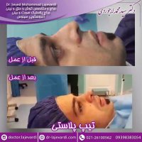 تیپ پلاستی توسط دکتر لاجوردی