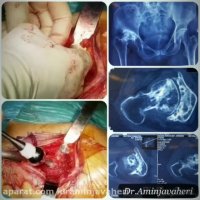 استبدال مفصل الحوض بالکامل