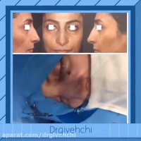 عمل جراحی زیبایی بینی