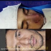 جراحی بینی در آقایان
