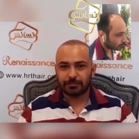 کاشت مو رنسانس - کلینیک تخصصی رنسانس
